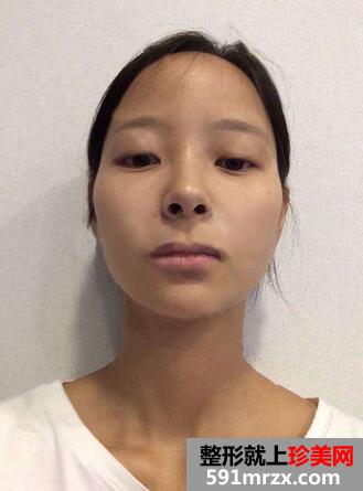 下颌角磨骨术恢复 前后效果对比