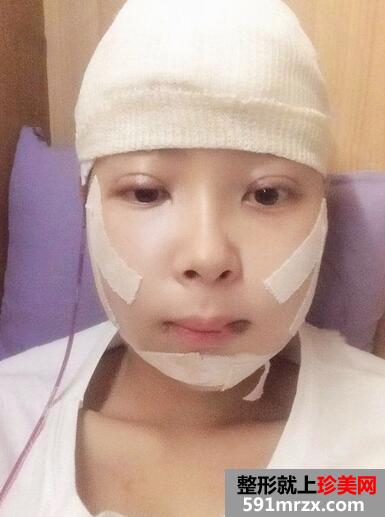 下颌角磨骨术恢复 前后效果对比