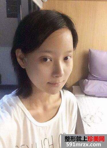 下颌角磨骨术恢复 前后效果对比