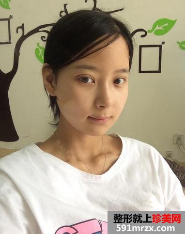 下颌角磨骨术恢复 前后效果对比