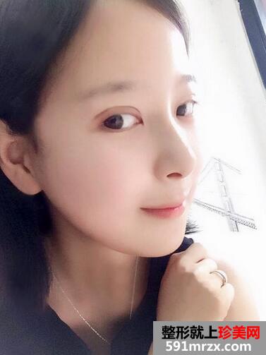 下颌角磨骨术恢复 前后效果对比