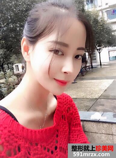 下颌角磨骨术恢复 前后效果对比