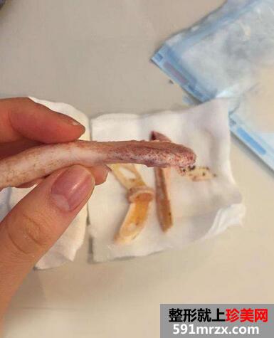 下颌角截骨术恢复期心路历程及照片分享