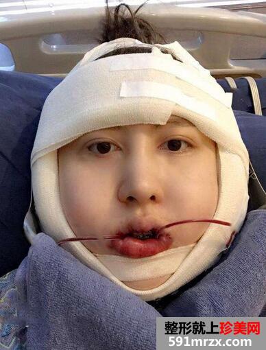 下颌角截骨术恢复期心路历程及照片分享