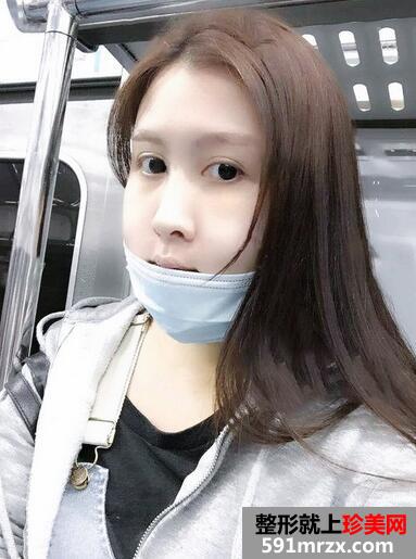 下颌角截骨术恢复期心路历程及照片分享