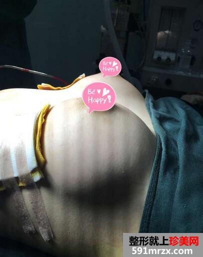 假体隆胸后恢复过程日记 假体隆胸恢复期有多长