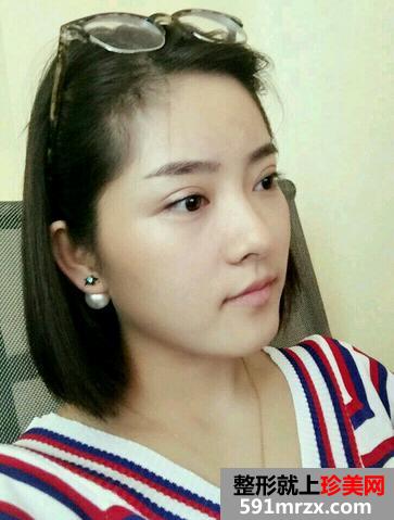 做完韩式三点恢复过程图