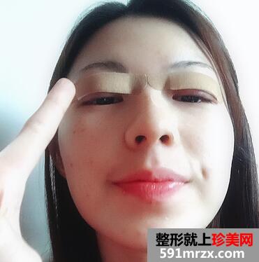 韩式芭比翘睫双眼皮恢复图