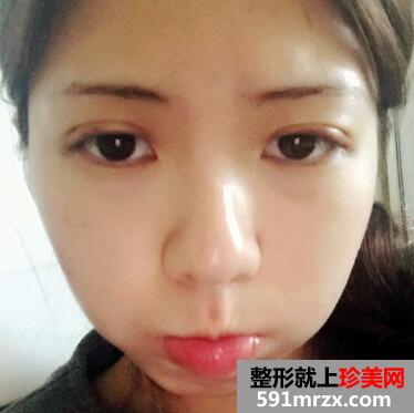 韩式芭比翘睫双眼皮恢复图