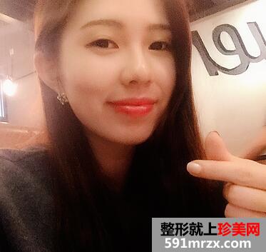 韩式芭比翘睫双眼皮恢复图