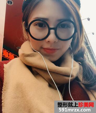 韩式芭比翘睫双眼皮恢复图