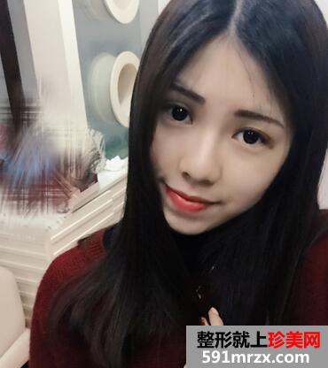 韩式芭比翘睫双眼皮恢复图