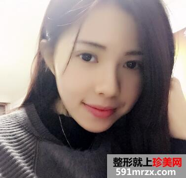 韩式芭比翘睫双眼皮恢复图