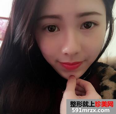 韩式芭比翘睫双眼皮恢复图
