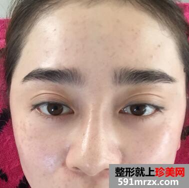 韩式翘睫双眼皮恢复图 前后效果对比