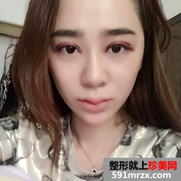韩式翘睫双眼皮恢复图 前后效果对比
