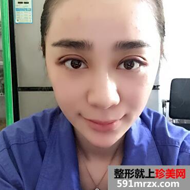 韩式翘睫双眼皮恢复图 前后效果对比