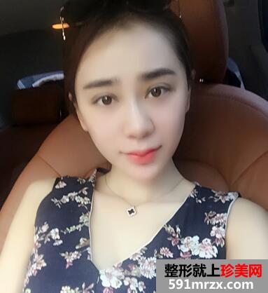 韩式翘睫双眼皮恢复图 前后效果对比