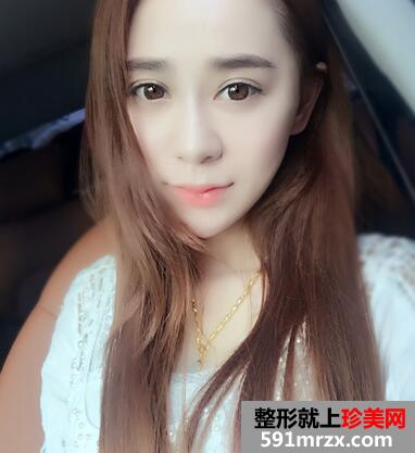 韩式翘睫双眼皮恢复图 前后效果对比