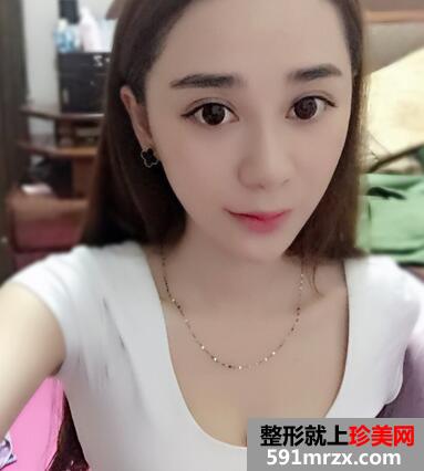 韩式翘睫双眼皮恢复图 前后效果对比