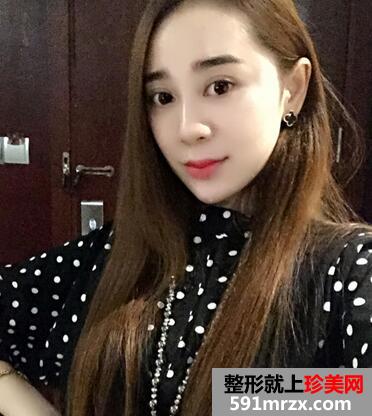 韩式翘睫双眼皮恢复图 前后效果对比