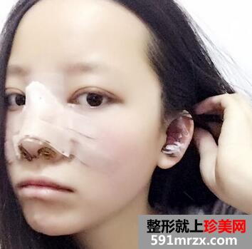 鼻综合整形的恢复经历