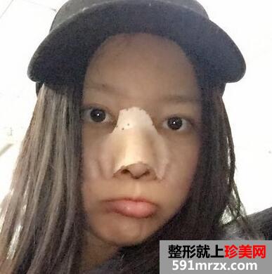 鼻综合整形的恢复经历