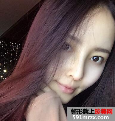 鼻综合整形的恢复经历