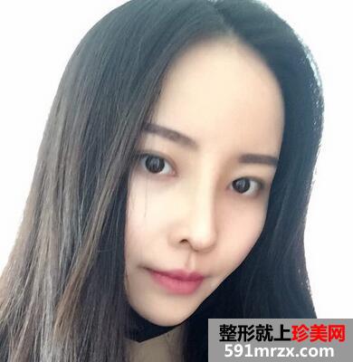 鼻综合整形的恢复经历