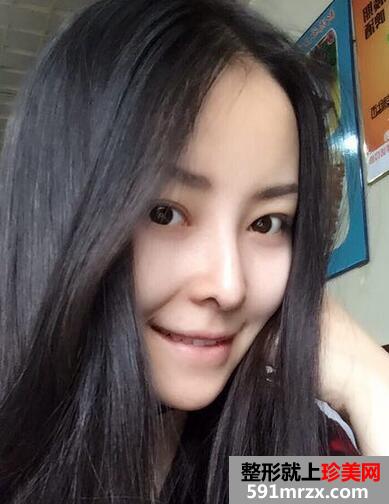 鼻综合整形的恢复经历