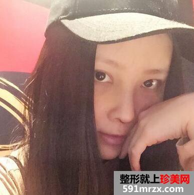 鼻综合整形的恢复经历