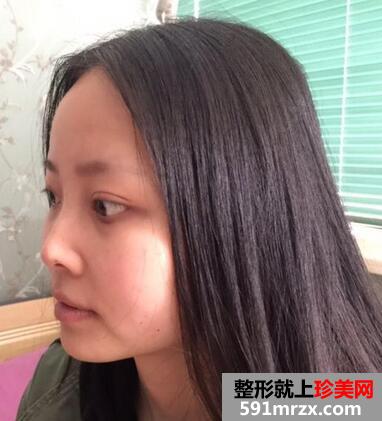鼻综合整形的恢复经历