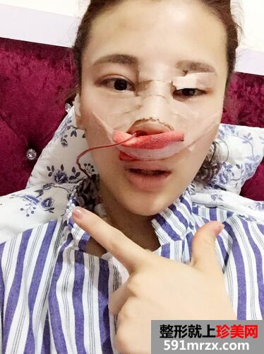 鼻综合手术恢复过程日记图