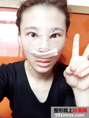 鼻综合手术恢复过程日记图