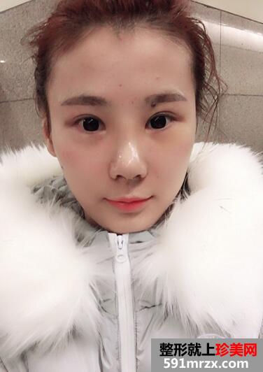 鼻综合手术恢复过程日记图