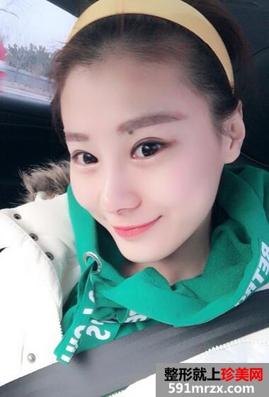 鼻综合手术恢复过程日记图