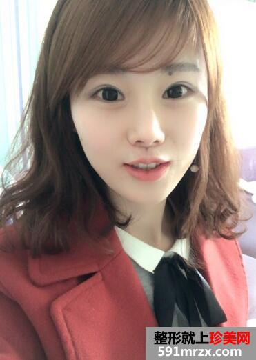 鼻综合手术恢复过程日记图