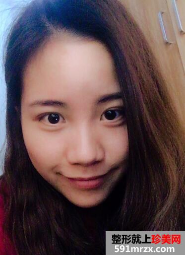 鼻综合真实恢复期图片