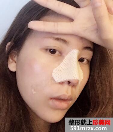 鼻综合真实恢复期图片