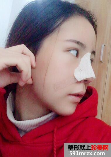 鼻综合真实恢复期图片