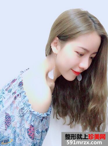 鼻综合真实恢复期图片