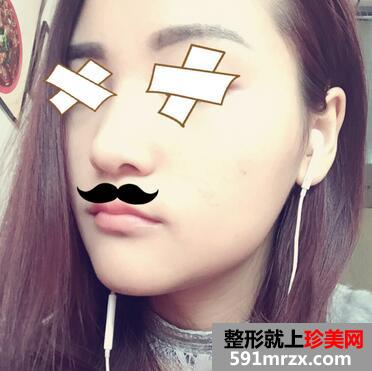 硅胶假体垫下巴恢复过程图