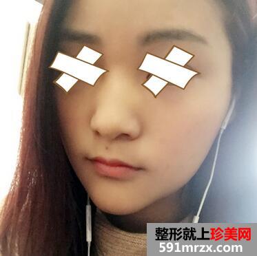 硅胶假体垫下巴恢复过程图