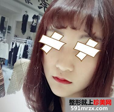 硅胶假体垫下巴恢复过程图