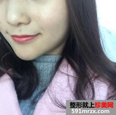 硅胶假体垫下巴恢复过程图