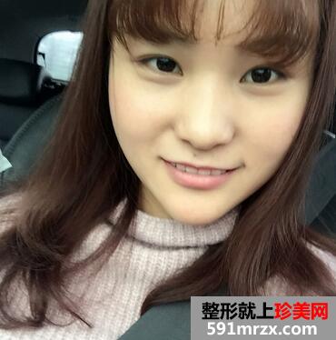 硅胶假体垫下巴恢复过程图