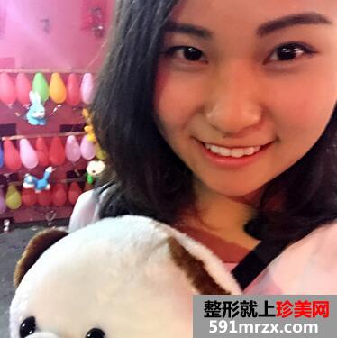 硅胶假体垫下巴恢复过程图