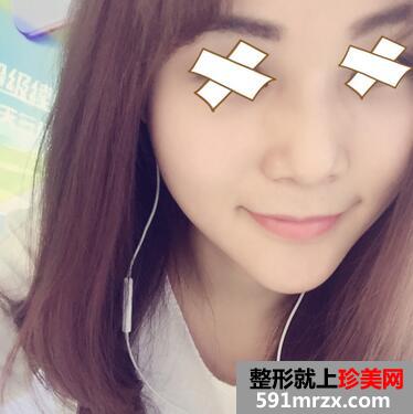 硅胶假体垫下巴恢复过程图