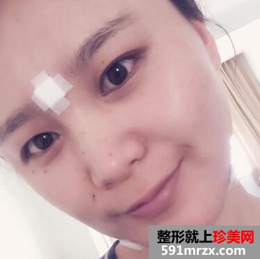 自体脂肪下巴填充前后对比图片