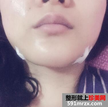 自体脂肪下巴填充前后对比图片